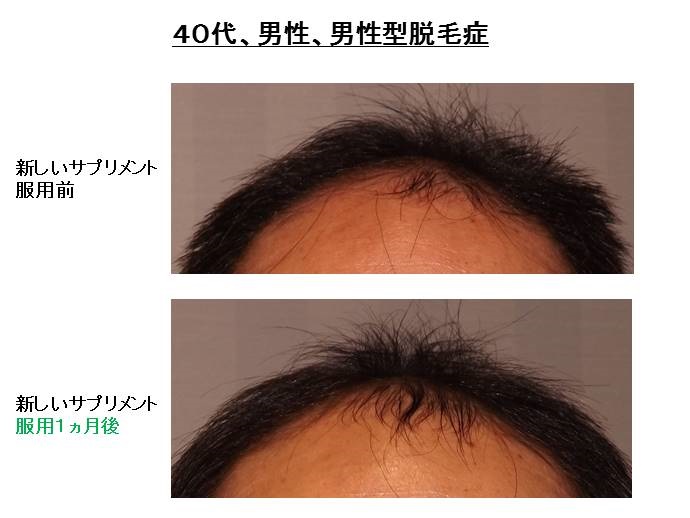 円形脱毛症　病院""